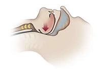 Fully obstructed airway (OSA)
